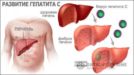 Вирусный гепатит С